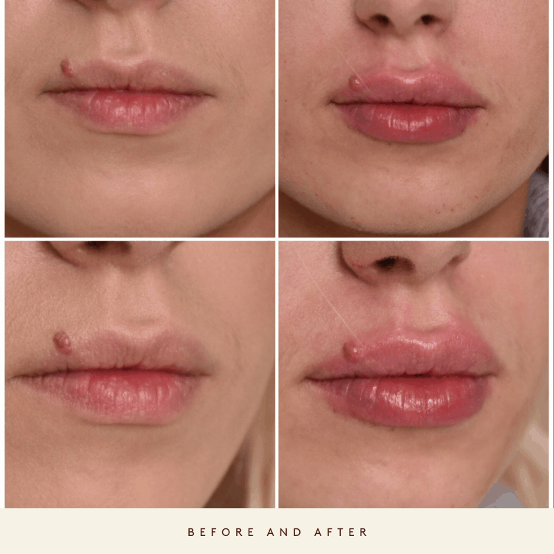 Dermal Lip treatment before and after