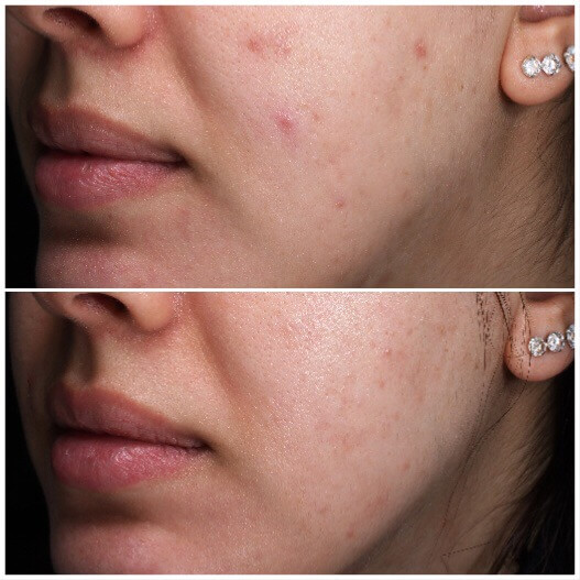 Treatment of carbon laser facial before and after