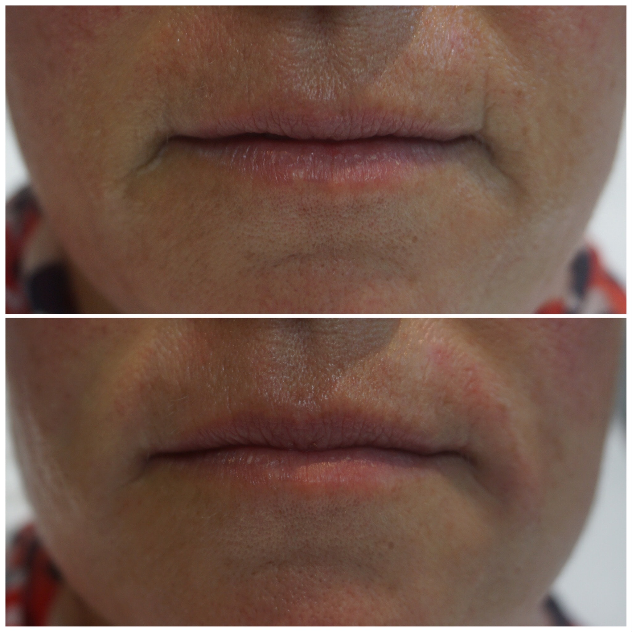 Dermal Lip treatment before and after