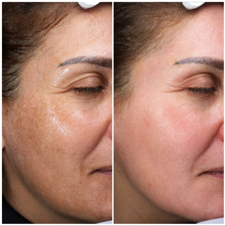 treatment for chemical peels