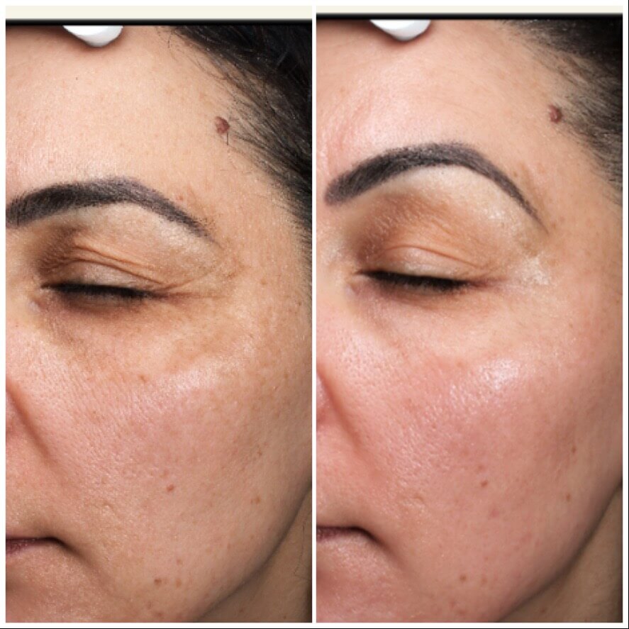 treatment for chemical peels