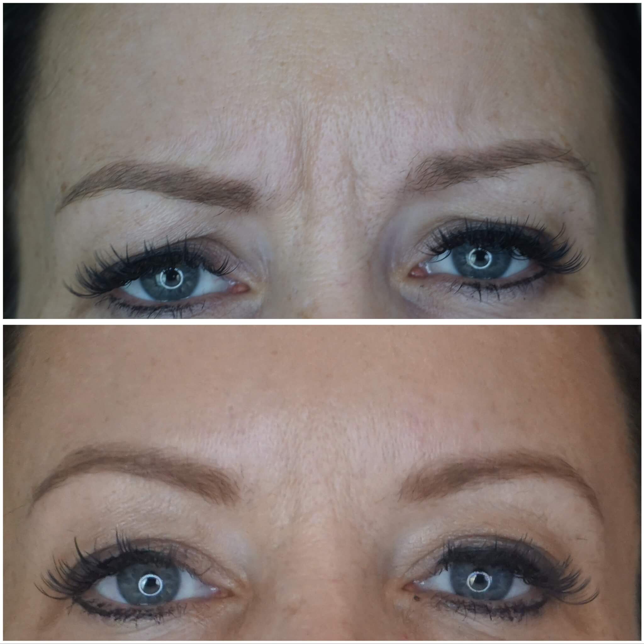 Anti Wrinkle treatment Before and after images