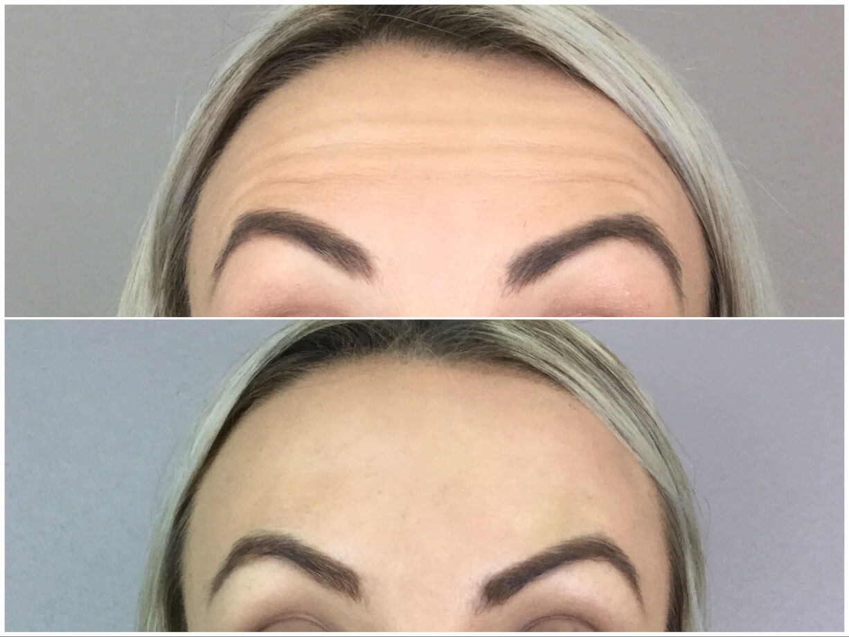 Anti Wrinkle treatment Before and after images