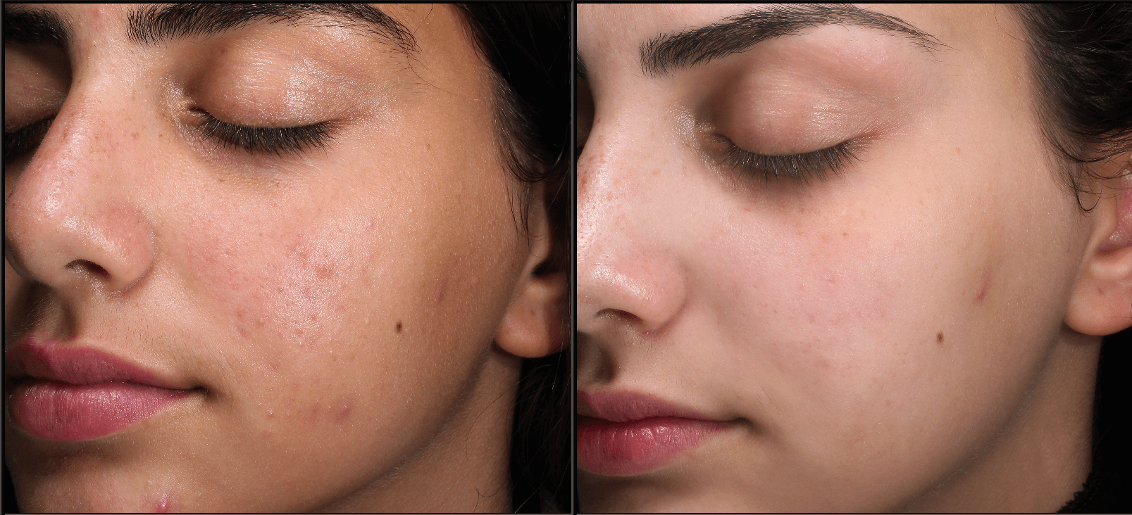 face skin clear before and after