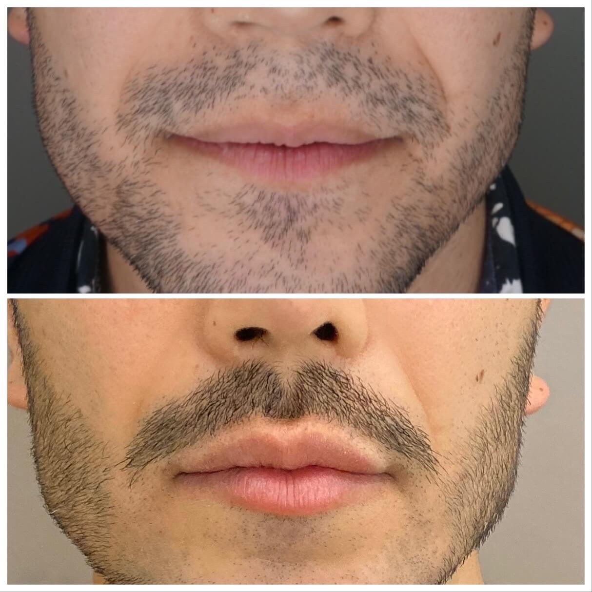 Treatment for beard of men before and after