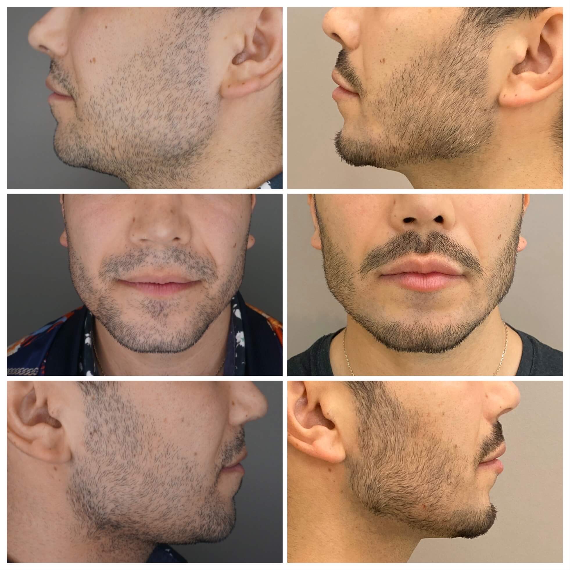Treatment for beard of men before and after