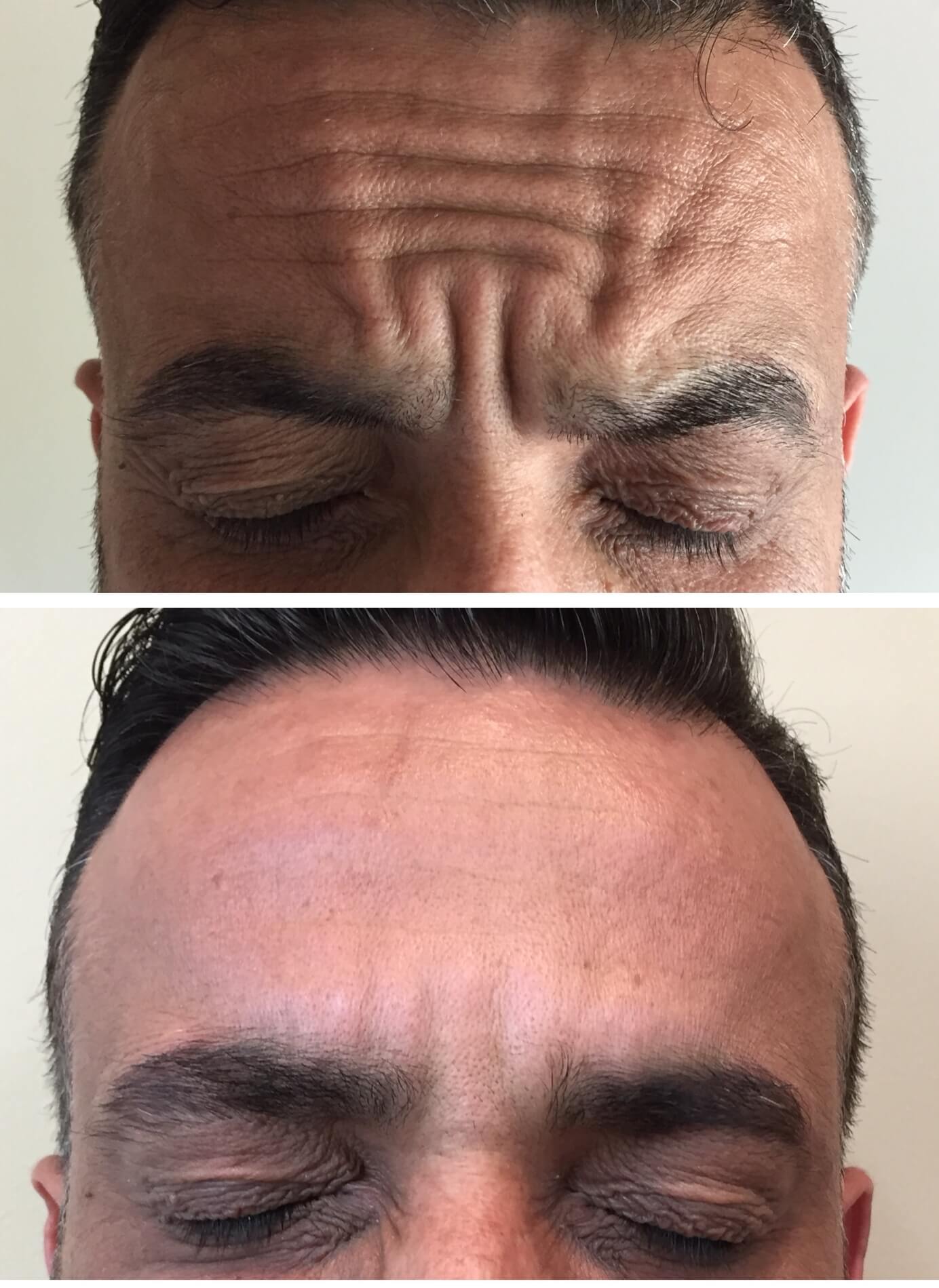 Forehead wrinkle treatment for men before and after